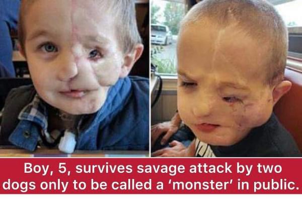 Boy, 5, survives savage attack by two dogs only to be called a ‘monster’ in public