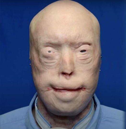 Patrick Hardison Received A New Face After Third-degree Burns, This Is Him Today